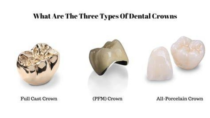 What are crowns?